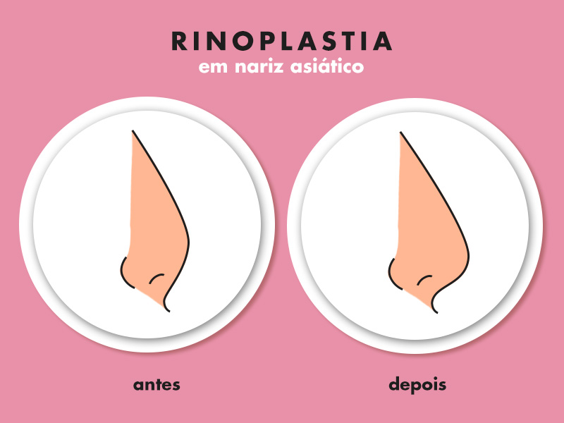 Ilustração com o antes e depois da rinoplastia em nariz asiático