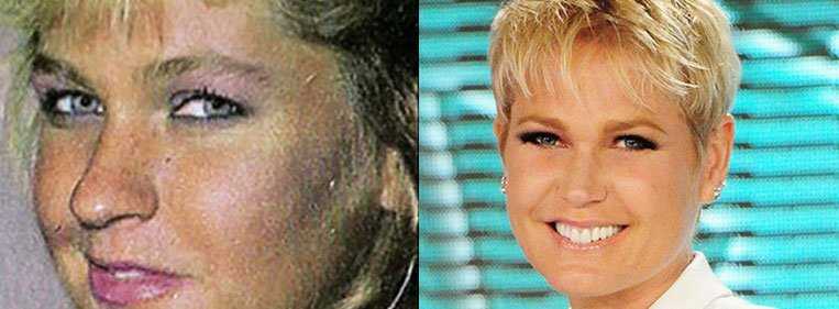 rinoplastia nariz largo antes e depois