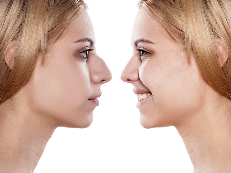 Imagem de uma mulher de frente para si mesma, antes e depois da cirurgia no nariz