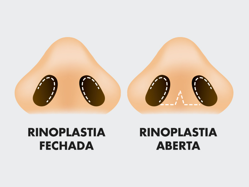 Ilustração com os dois tipos técnicas de cirurgias no nariz, que é a rinoplastia fechada e aberta