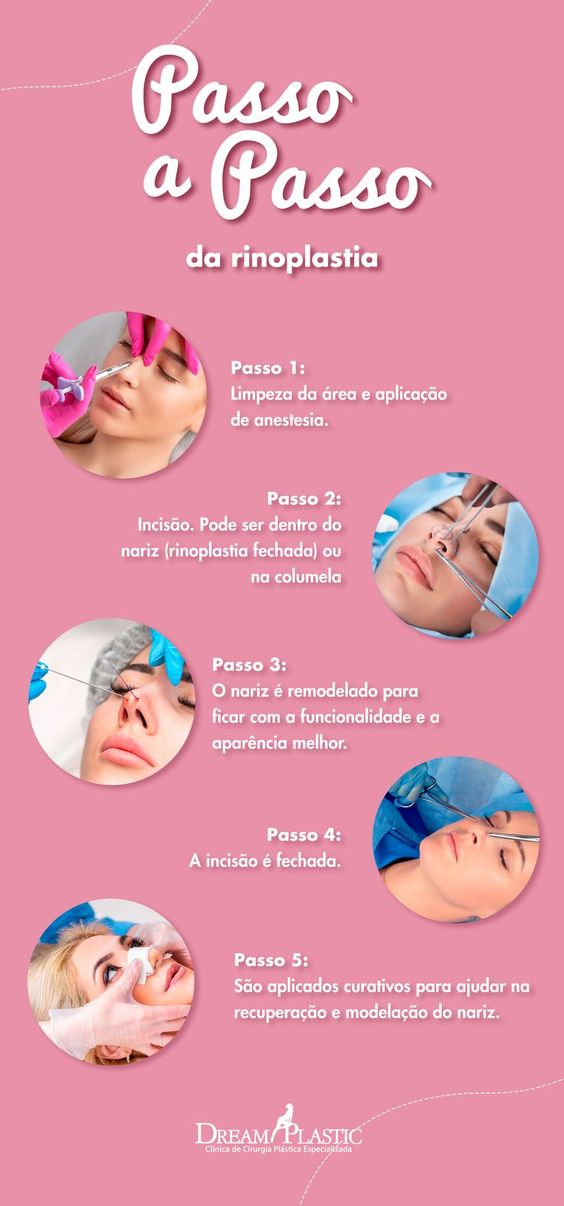 Passo a passo da cirurgia de rinoplastia