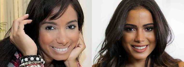 Nariz da Anitta antes e depois
