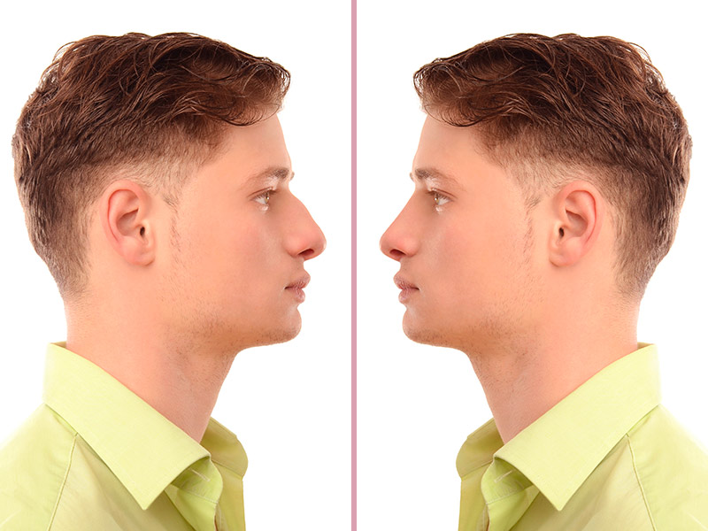 Imagem com o antes e depois da rinoplastia masculina