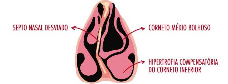 desvio nariz
