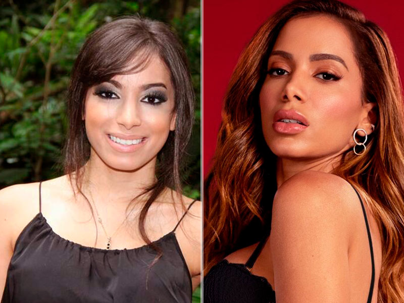 Imagem com o antes e depois do nariz da Anitta com rinoplastia