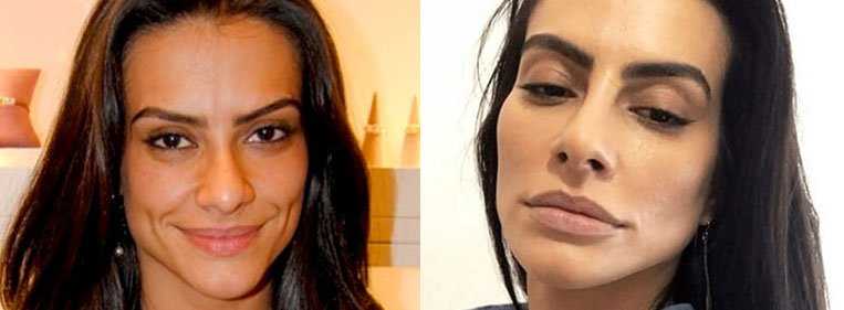 rinoplastia famosos