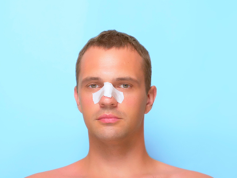 Imagem de um homem com curativo no nariz, que é necessário utilizar no pós-operatório da rinoplastia