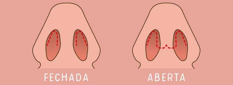 septoplastia e rinoplastia