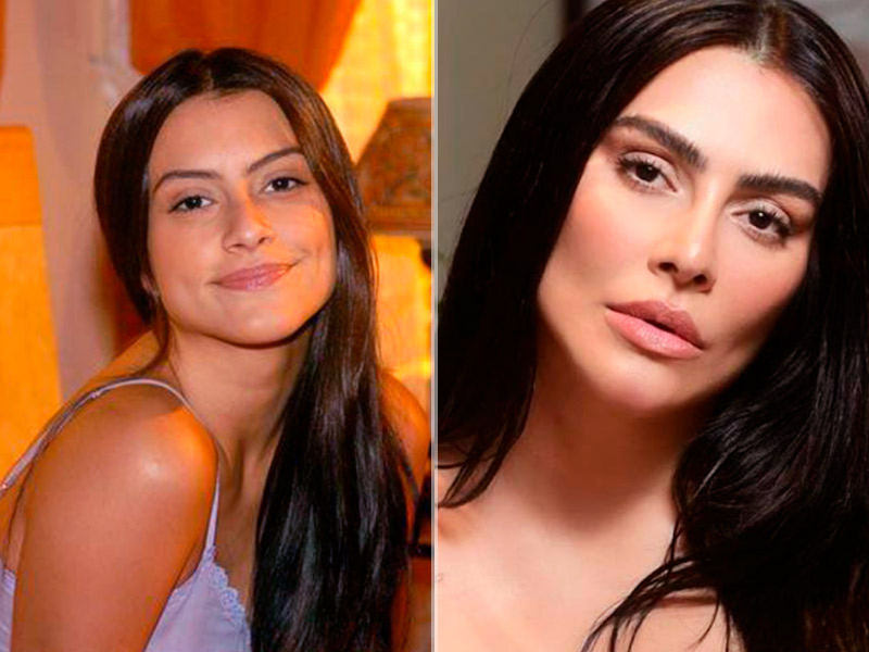 Foto com o resultado da rinoplastia da famosa Cléo Pires