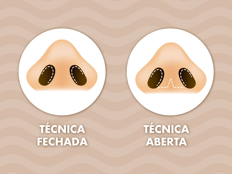 Ilustração com os tipos de cicatriz da rinosseptoplastia, dependendo da técnica aberta ou fechada