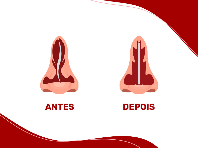 Ilustração que mostra o antes e depois da cirurgia de septoplastia