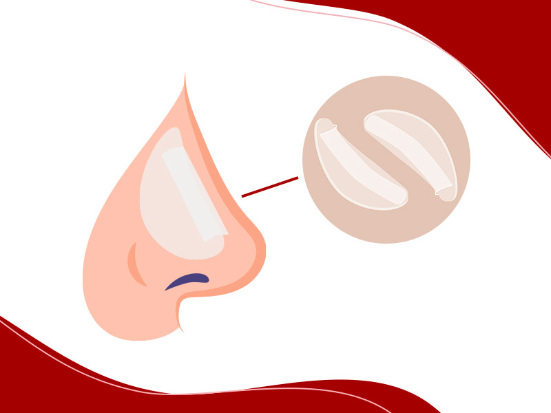 Ilustração que mostra um splint nasal e como ele fica dentro do nariz