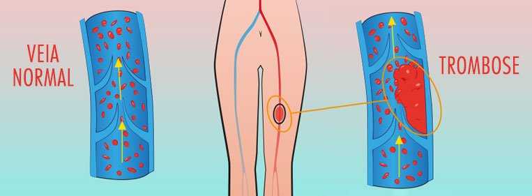 riscos da lipoaspiração