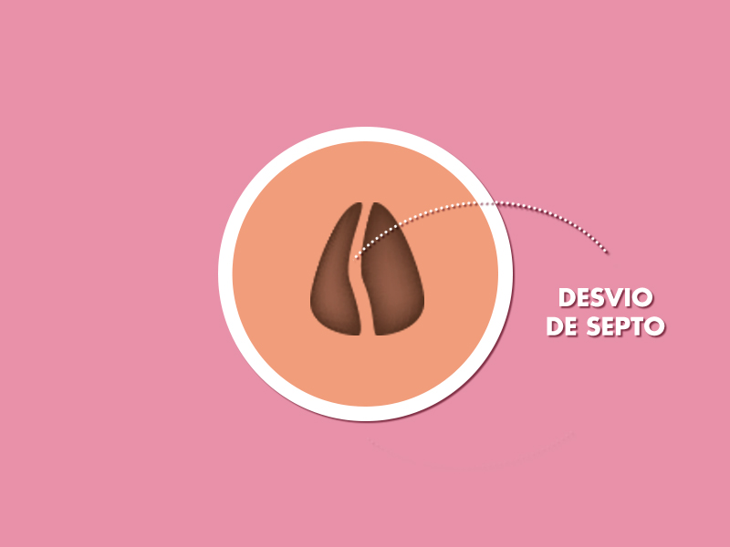 O que é desvio de septo? Ilustração exemplificando como é o desvio septo na parte interna do nariz