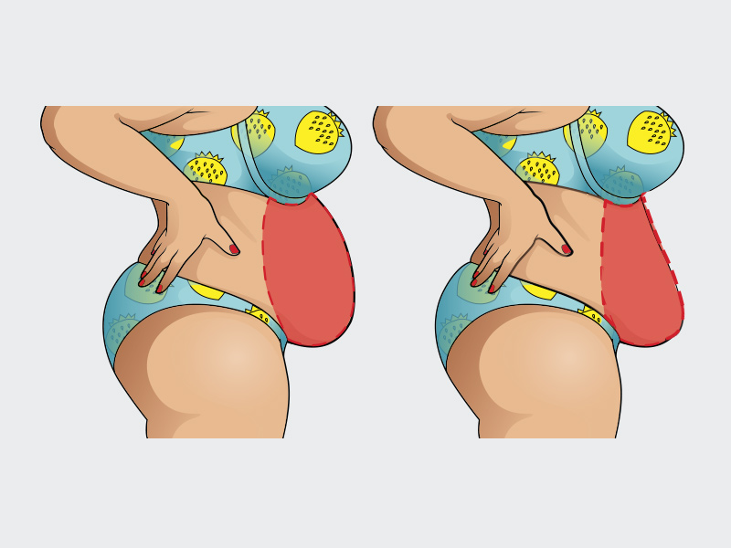 Ilustração da lipo gessada antes e depois do procedimento