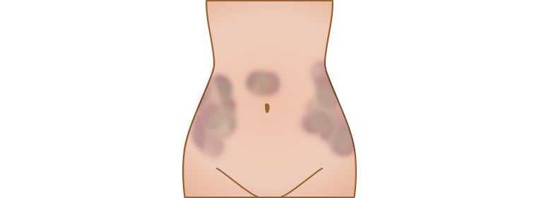 quais os riscos da lipoaspiração