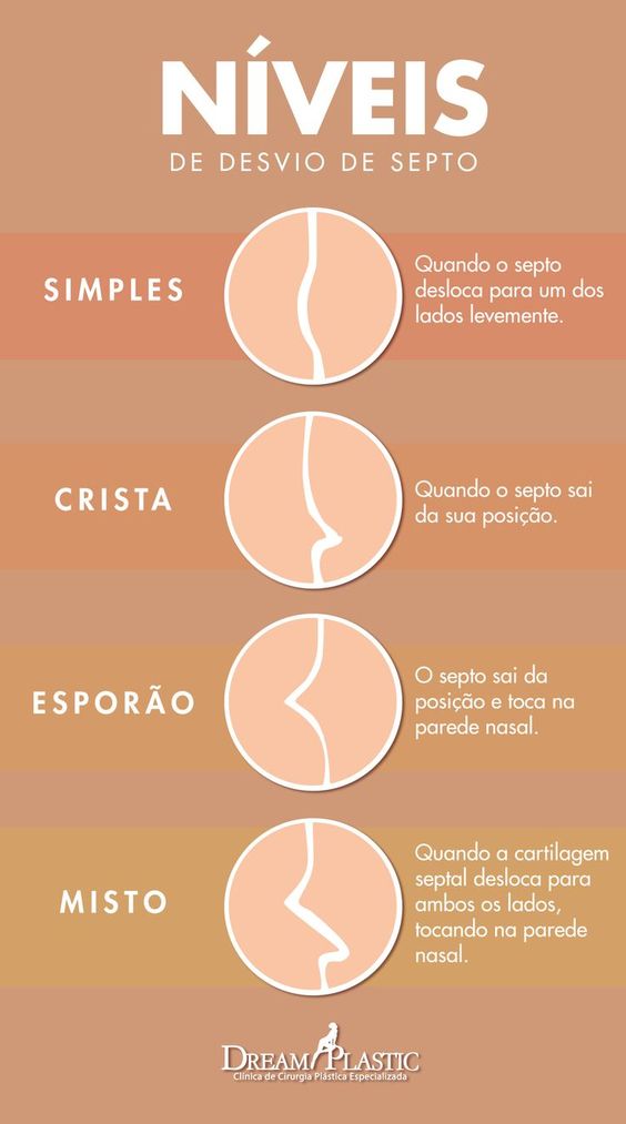 Infográfico que mostra os 4 níveis de desvio de septo, do mais suave até um grande deslocamento