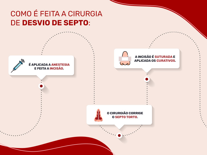 Infográfico que mostra o passo a passo da cirurgia de desvio de septo