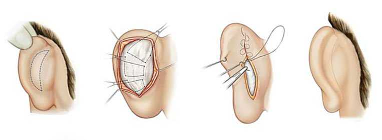 Como é feita a cirurgia de orelha de abano