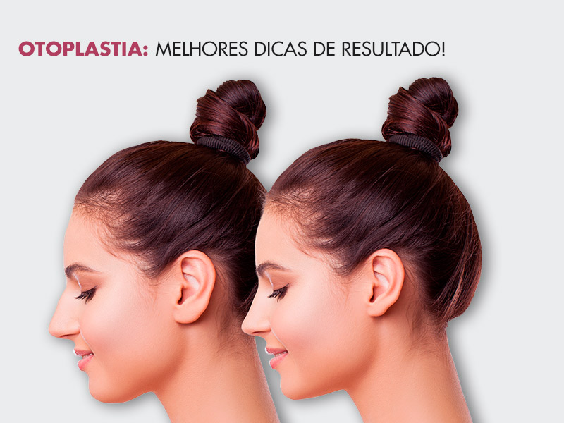 Otoplastia antes e depois: fotos de famosos e dicas para conquistar o melhor resultado em orelhas de abano! otoplastia antes depois