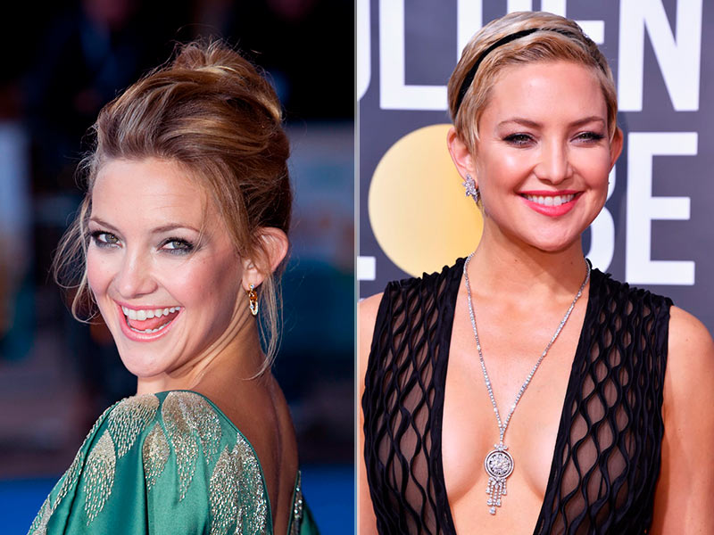 Antes e depois da otoplastia da kate hudson 