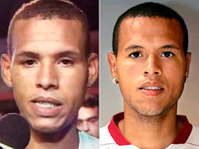 Antes e depois da cirurgia de orelha do Luís Fabiano