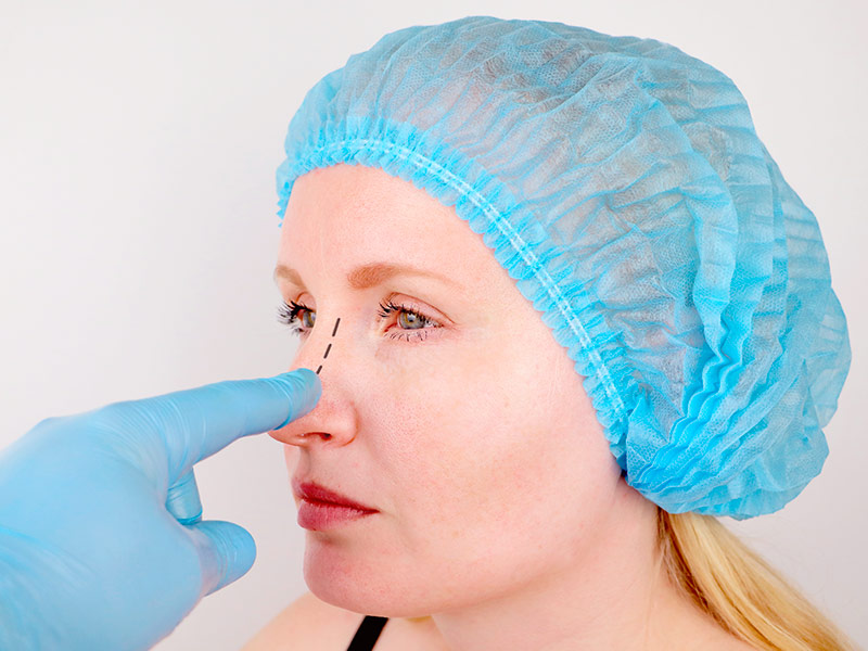 Rinoplastia para nariz grande funciona? rinoplastia nariz grande