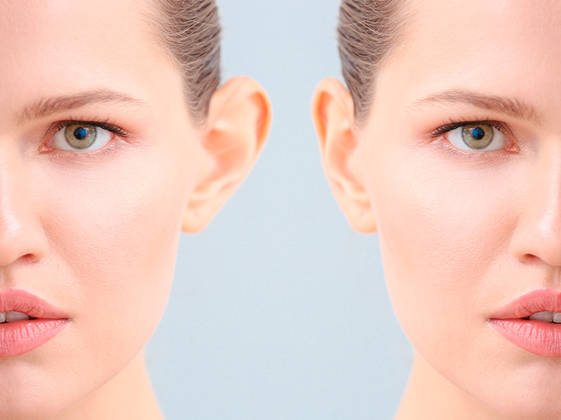 Antes e depois da cirurgia de orelha de abano em mulher