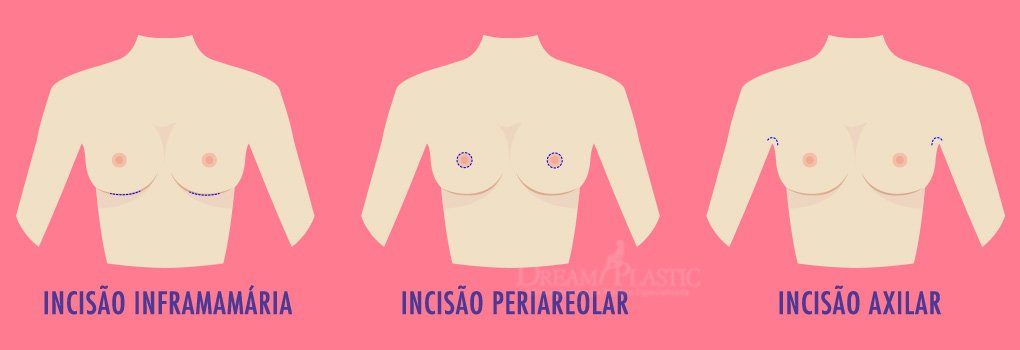 Cicatriz prótese de silicone