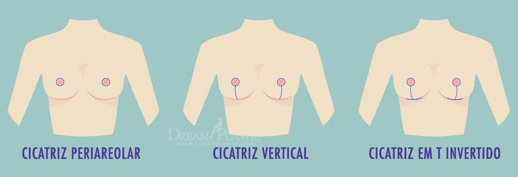 cicatriz mastopexia