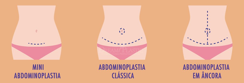Cicatriz de abdominoplastia