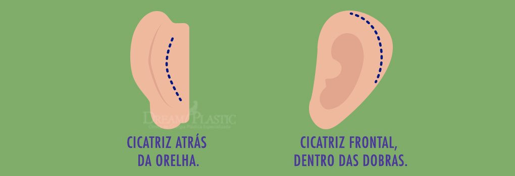 cicatriz otoplastia
