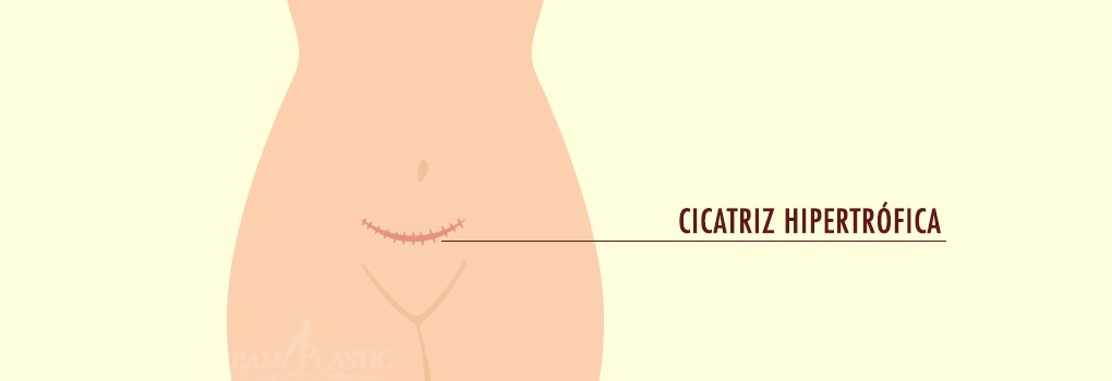 cicatriz hipertrófica