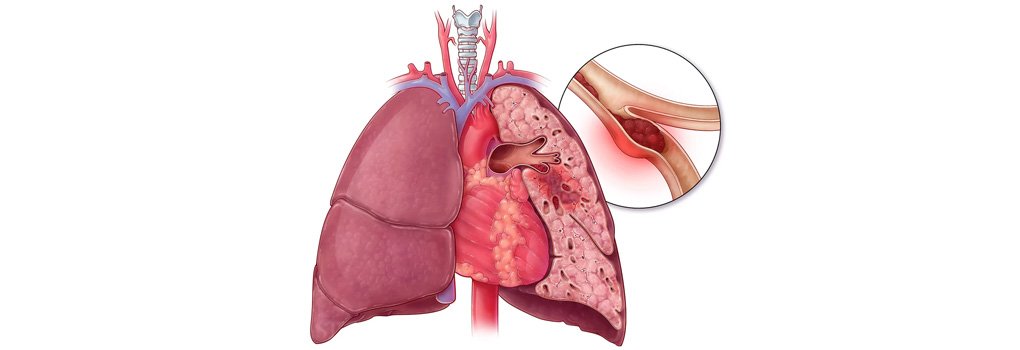 embolia pulmonar em cirurgia plástica