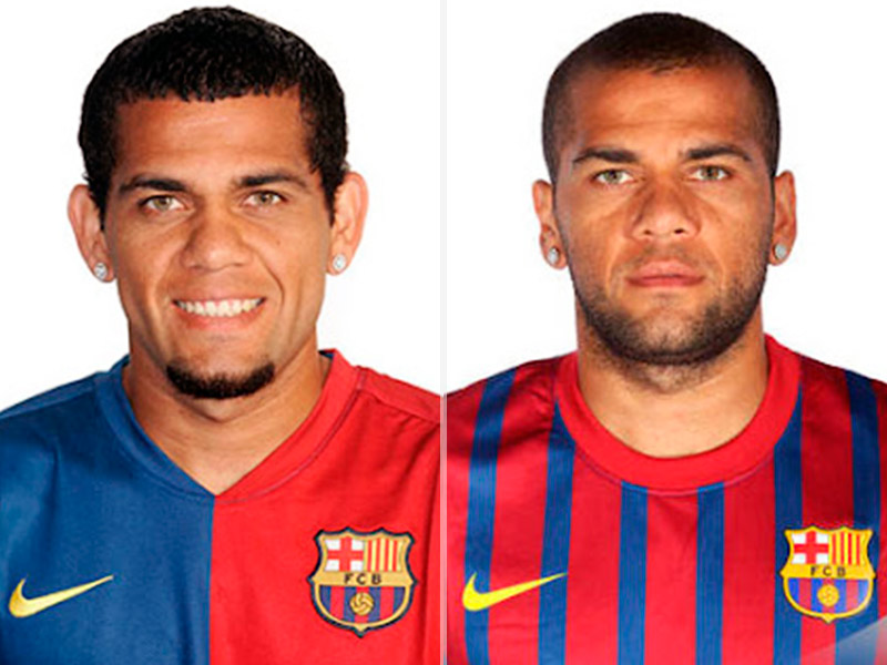 Resultado da otoplastia do Daniel Alves artistas fizeram otoplastia