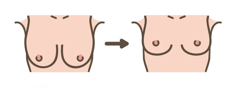 O que é mastopexia?