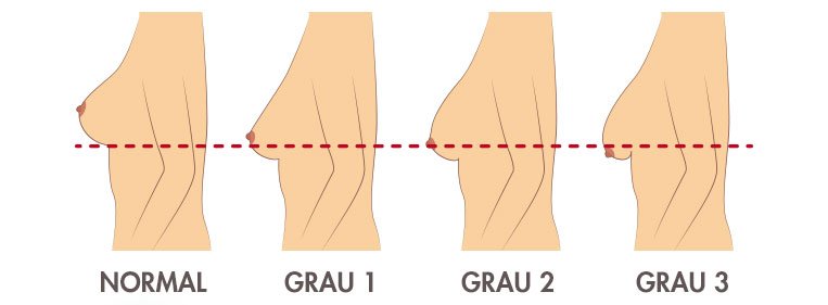 cirurgia mastopexia