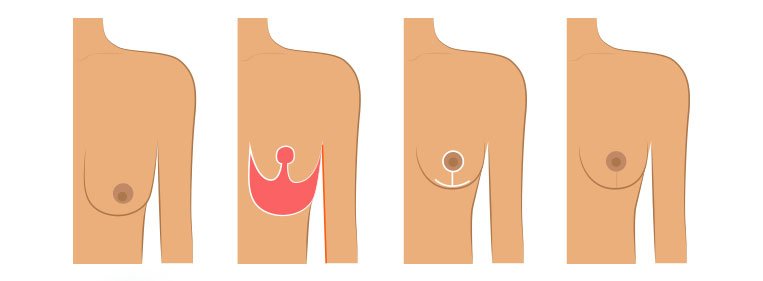 Como é feita a cirurgia de mastopexia? Como é feita a cirurgia de mastopexia?