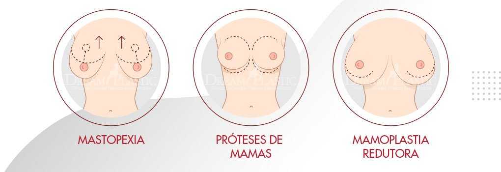 3 opções de cirurgia de mamoplastia cirurgia mamoplastia