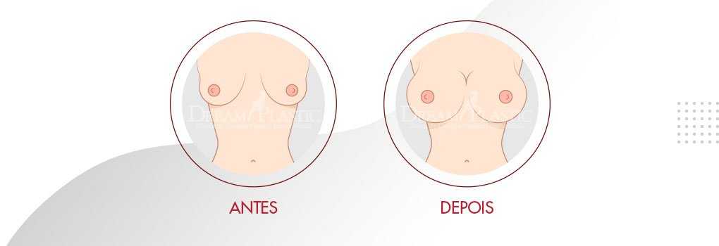 Mamoplastia de aumento para os seios pequenos Mamoplastia de aumento