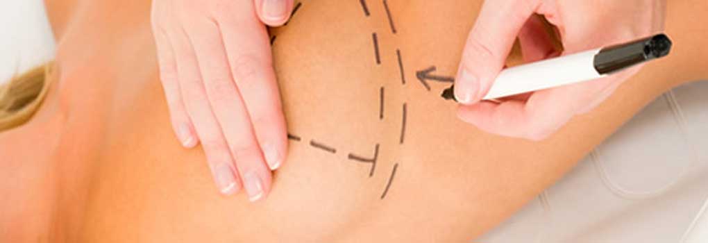 prótese de silicone com mastopexia