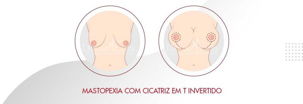Mamoplastia sem prótese para as mamas caídas Mamoplastia sem prótese