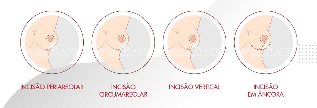 mastopexia cicatrizes