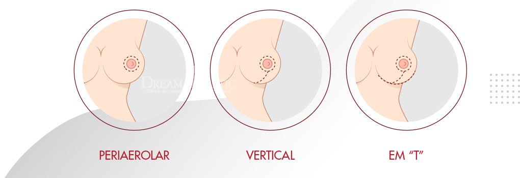 mastopexia periareolar