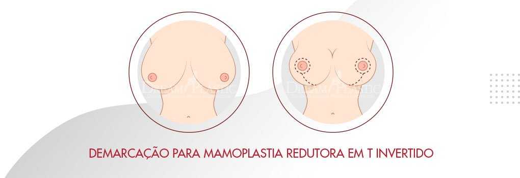 Mamoplastia Redutora para diminuir o volume Mamoplastia Redutora