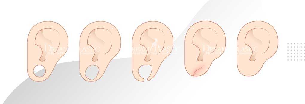 cirurgia para diminuir a orelha