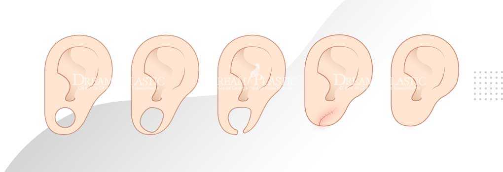 Lobuloplastia: Cirurgia para fechar orelha alargada cirurgia para diminuir a orelha