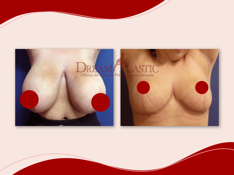 Antes e depois da cirurgia de gigantomastia, para reduzir mamas gigantes