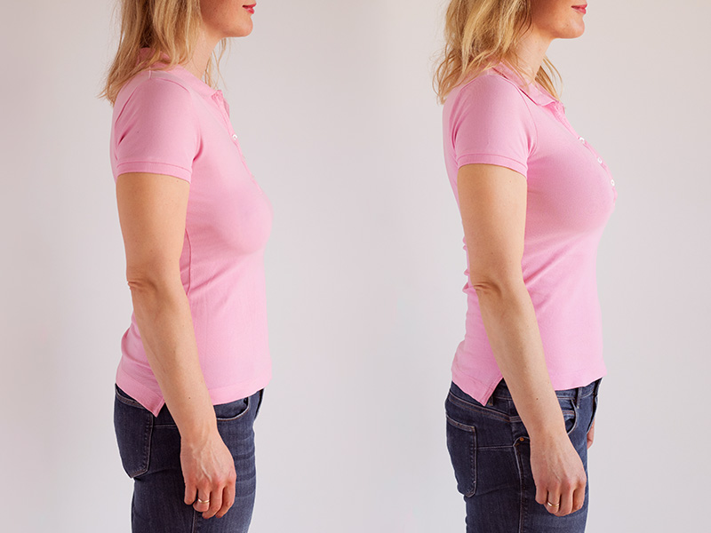 Como é o antes e depois da cirurgia para levantar a mama? cirurgia levantar mama antes depois