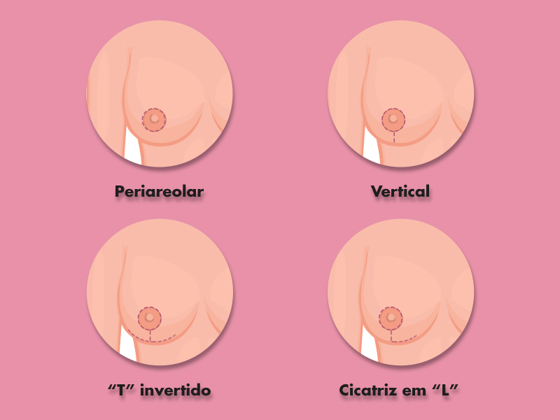 Como é a cicatriz da cirurgia para levantar a mama? cicatriz cirurgia levantar mama